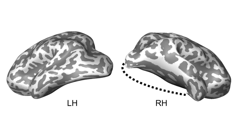 A representation of the brain matter the patient had removed from his right brain hemisphere at age six.